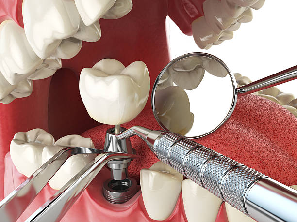 Best Chipped Tooth Repair Near Me  in Auburn, KS